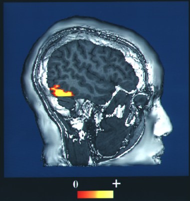Misteri Wajah Asing: Menyingkap Prosopagnosia, Buta Wajah yang Menghantui